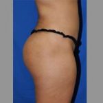 Buttock Augmentation Before & After Patient #7696