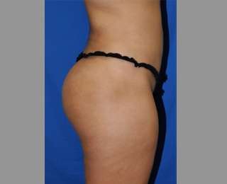 Buttock Augmentation Before & After Patient #7696