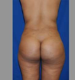 Buttock Augmentation Before & After Patient #7696