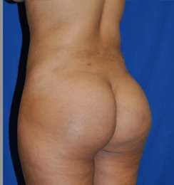 Buttock Augmentation Before & After Patient #7696