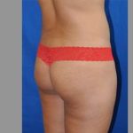 Buttock Augmentation Before & After Patient #7696