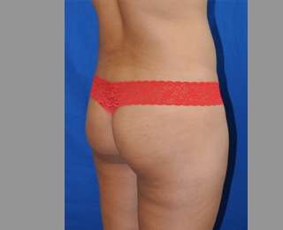Buttock Augmentation Before & After Patient #7696
