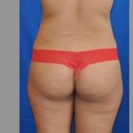 Buttock Augmentation Before & After Patient #7696