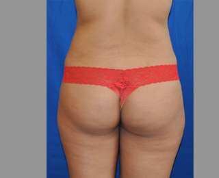 Buttock Augmentation Before & After Patient #7696
