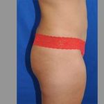 Buttock Augmentation Before & After Patient #7696