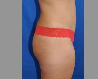 Buttock Augmentation Before & After Patient #7696