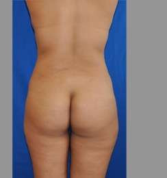 Buttock Augmentation Before & After Patient #7696