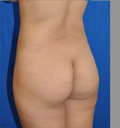 Buttock Augmentation Before & After Patient #7696
