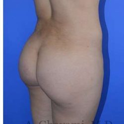 Buttock Augmentation Before & After Patient #7685