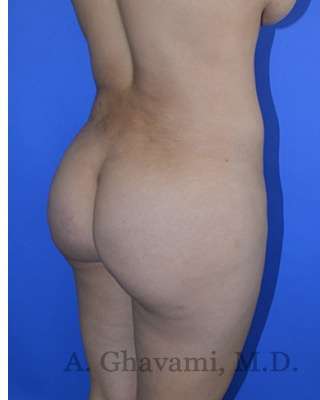 Buttock Augmentation Before & After Patient #7685