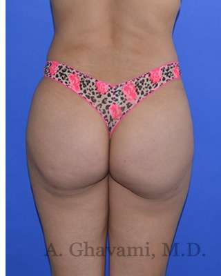 Buttock Augmentation Before & After Patient #7685