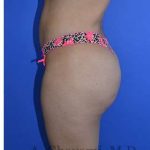 Buttock Augmentation Before & After Patient #7685