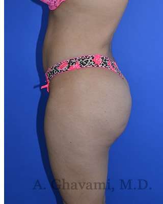 Buttock Augmentation Before & After Patient #7685