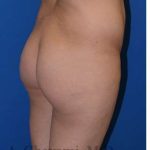 Buttock Augmentation Before & After Patient #7685