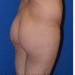 Buttock Augmentation Before & After Patient #7685