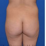 Buttock Augmentation Before & After Patient #7685