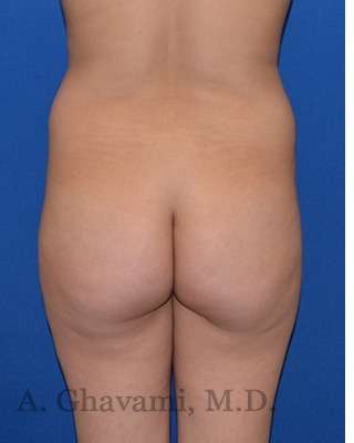 Buttock Augmentation Before & After Patient #7685