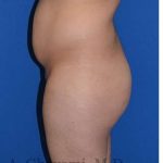 Buttock Augmentation Before & After Patient #7685