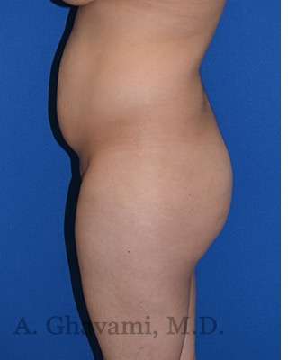 Buttock Augmentation Before & After Patient #7685