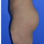 Buttock Augmentation Before & After Patient #8272