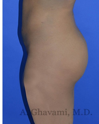 Buttock Augmentation Before & After Patient #8272