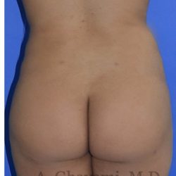 Buttock Augmentation Before & After Patient #8272