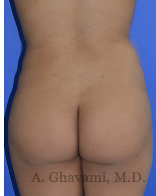 Buttock Augmentation Before & After Patient #8272