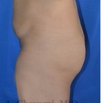 Buttock Augmentation Before & After Patient #8272