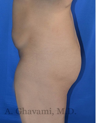 Buttock Augmentation Before & After Patient #8272