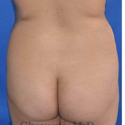 Buttock Augmentation Before & After Patient #8272