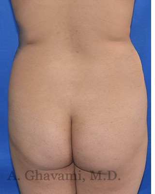 Buttock Augmentation Before & After Patient #8272