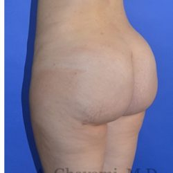Buttock Augmentation Before & After Patient #8277