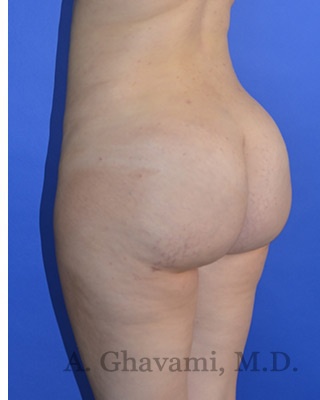 Buttock Augmentation Before & After Patient #8277