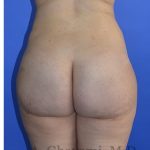 Buttock Augmentation Before & After Patient #8277