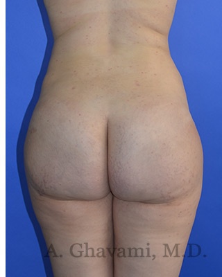 Buttock Augmentation Before & After Patient #8277