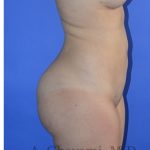 Buttock Augmentation Before & After Patient #8277