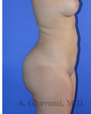 Buttock Augmentation Before & After Patient #8277