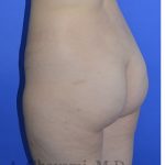 Buttock Augmentation Before & After Patient #8277