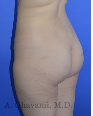 Buttock Augmentation Before & After Patient #8277