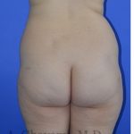 Buttock Augmentation Before & After Patient #8277