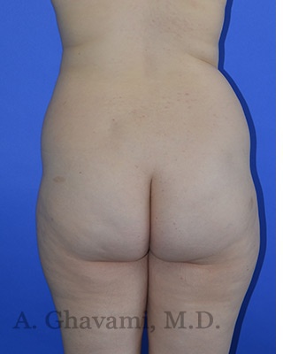Buttock Augmentation Before & After Patient #8277