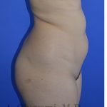 Buttock Augmentation Before & After Patient #8277