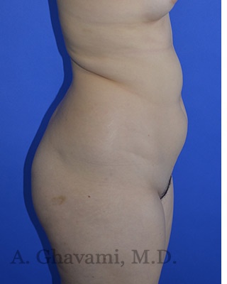 Buttock Augmentation Before & After Patient #8277