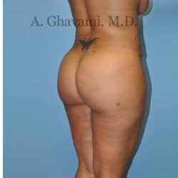 Buttock Augmentation Before & After Patient #8284