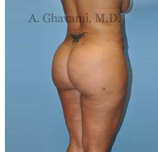 Buttock Augmentation Before & After Patient #8284