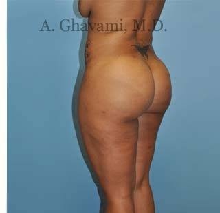 Buttock Augmentation Before & After Patient #8284
