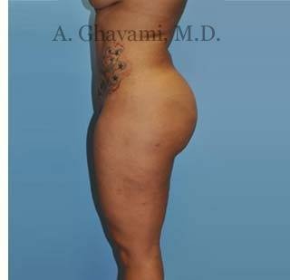 Buttock Augmentation Before & After Patient #8284