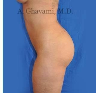 Buttock Augmentation Before & After Patient #8284