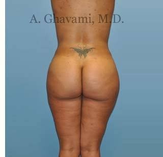 Buttock Augmentation Before & After Patient #8284