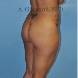 Buttock Augmentation Before & After Patient #8284